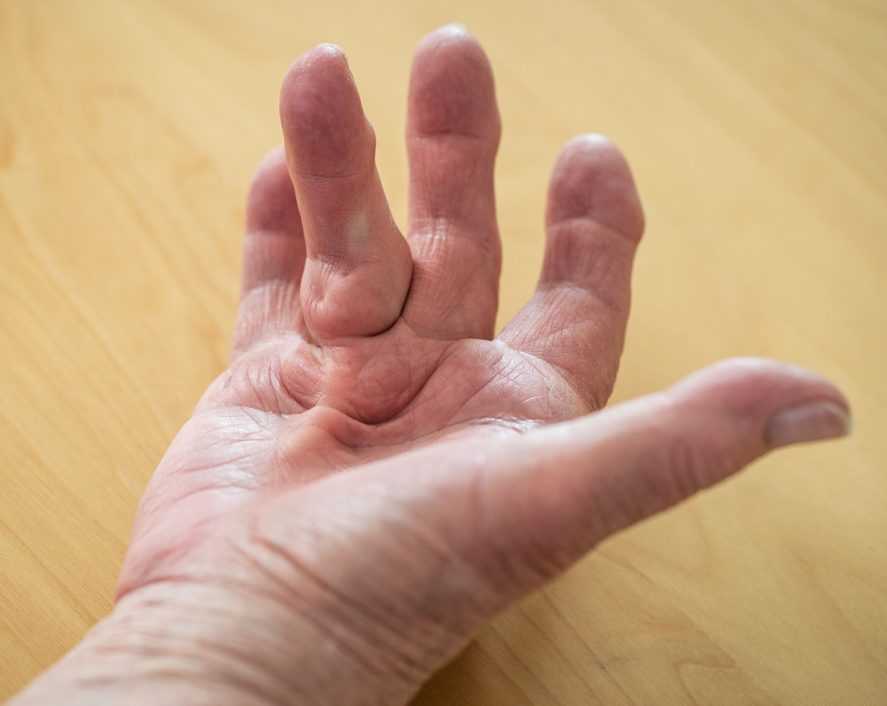 What is Dupuytren's disease?